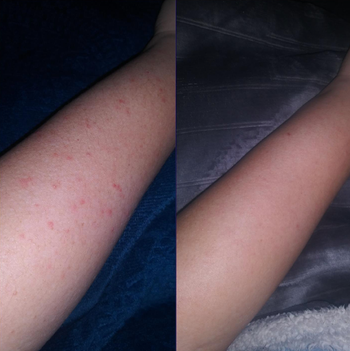 Reviewer’s before photo of an arm with red bumps and an after photo showing the same arm completely clear