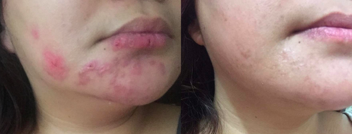 A customer's before and after photo showing their skin with acne and then clear after using the oil