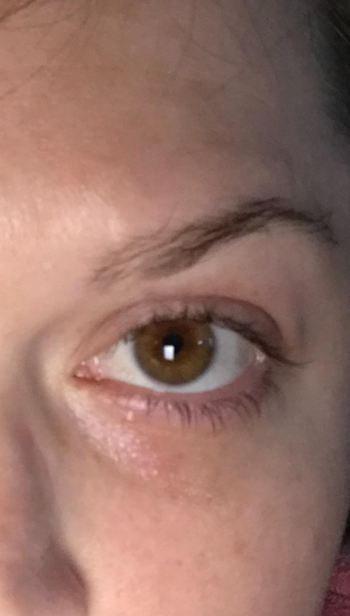The same reviewer’s eye now looking refreshed and no longer puffy, thanks to the ice roller