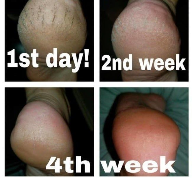 A person’s severely cracked and painful heel, followed by improvement after two weeks, and fully healed after four weeks of use