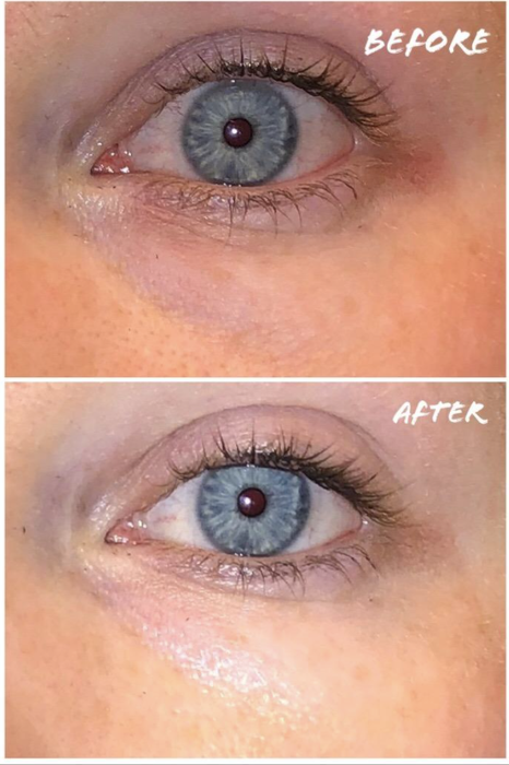 reviewer's before photo showing red and inflamed under-eye area, followed by improvement