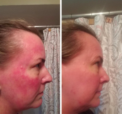Reviewer’s photo: severe, blotchy rosacea covering their face, followed by a significant reduction in redness and irritation