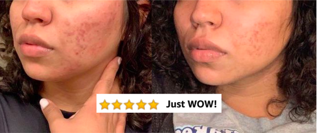 Reviewer's before-and-after photos showing a breakout on their cheek and then clear skin with a caption