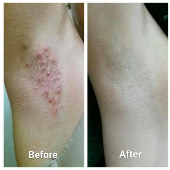 Before and after photos of an underarm: first, covered in red razor bumps; then, completely smooth