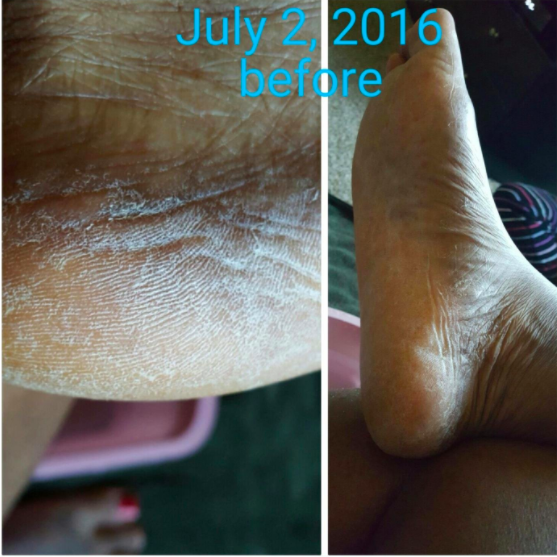 A before photo of rough, crusty feet dated July 2