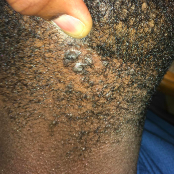 Reviewer’s photo showing large razor bumps on the back of their head