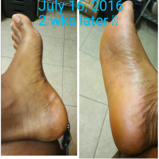 After photo dated July 16, two weeks later, revealing baby-smooth feet