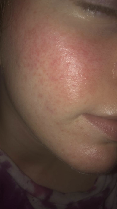 The same reviewer’s photo with the breakout almost completely healed