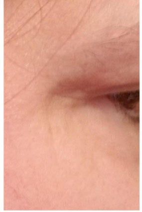 the crow's feet significantly diminished