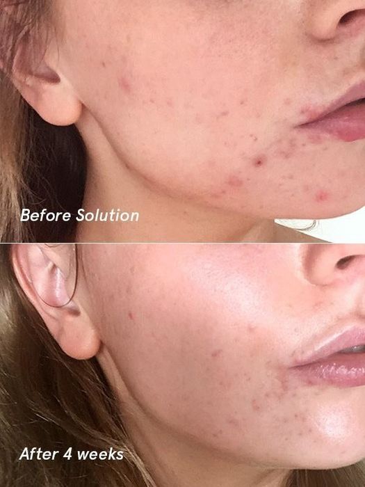 Before photo of a person with redness and scarring, followed by significant improvement after four weeks of use