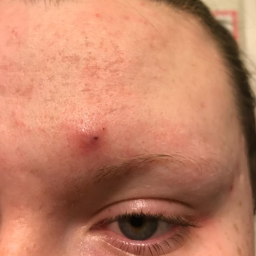 Reviewer’s photo of a large, inflamed pimple above their eyebrow