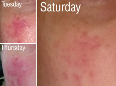 Reviewer’s photo series: a bright rosacea breakout patch, followed by noticeable lightening two days after treatment, and further improvement four days later