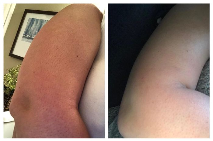 before and after photos of a reviewer's skin, transitioning from bumpy to smooth