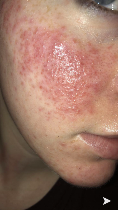 Reviewer’s photo showcasing a painful, inflamed rosacea breakout on their cheek