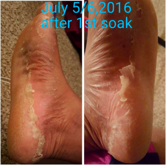 Photos dated July 5 and 6 after the first soak, showing skin beginning to peel