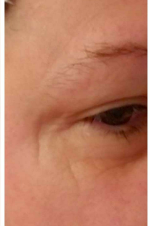 Reviewer’s photo showing deep crow’s feet beside their eye