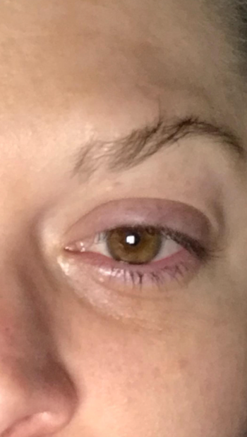 Reviewer’s puffy eye before using the ice roller