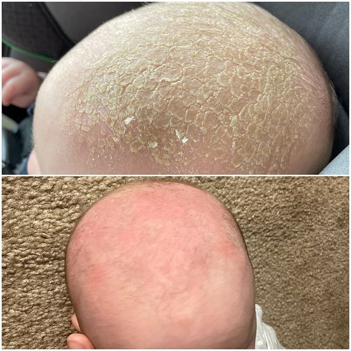 a reviewer’s child’s head showing dry scales before and a smooth, flake-free scalp after treatment