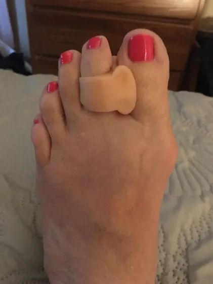 The toe separator in action, preventing toes from overlapping