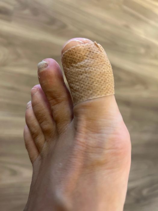 The writer’s big toe is wrapped with precut blister prevention tape