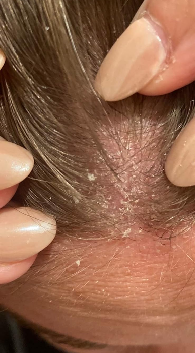 A close-up view of a reviewer's scalp showing dandruff