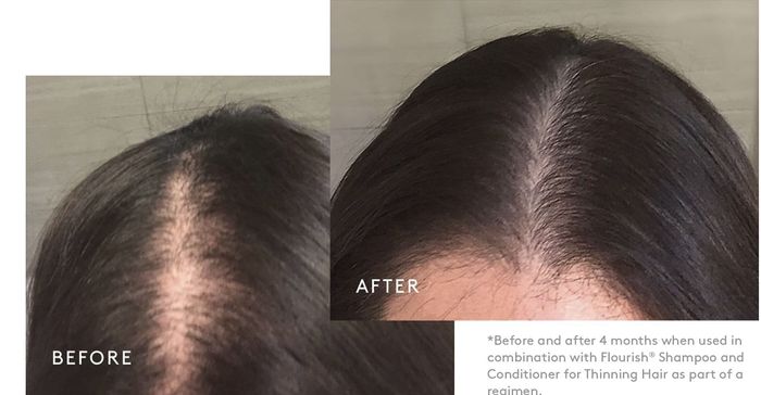Side-by-side images demonstrating hair growth progress after using Flourish Shampoo and Conditioner for thinning hair over a 4-month period