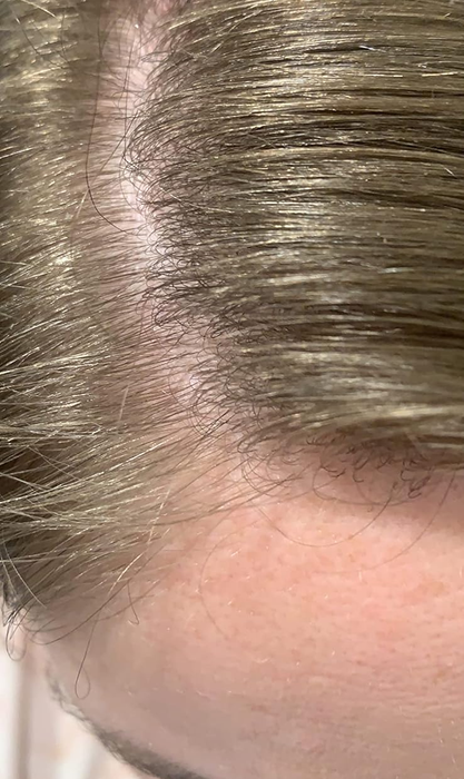 A close-up view of a reviewer's scalp and hairline, now free of dandruff