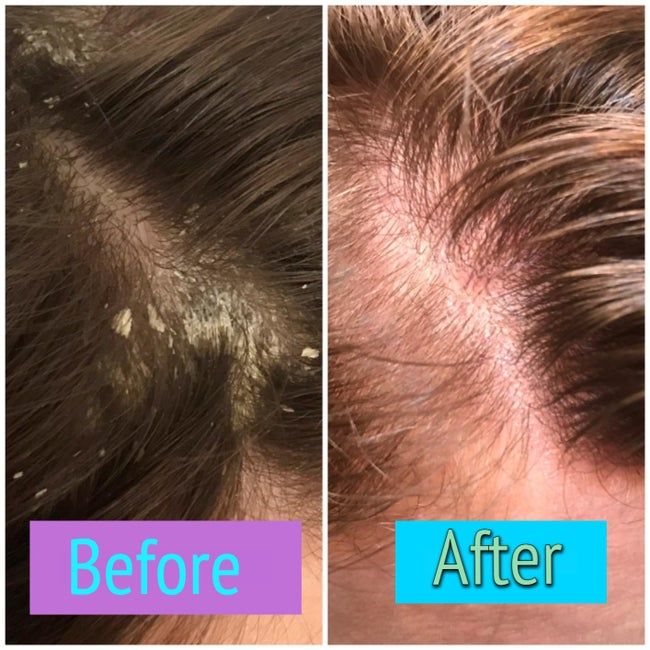 A reviewer's scalp before and after using the shampoo, showing the complete elimination of dandruff