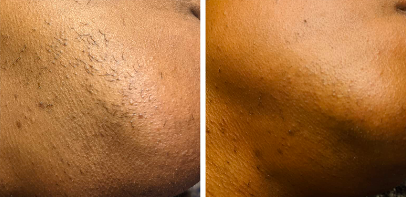 A reviewer's chin before and after waxing, showcasing the hair removal results.