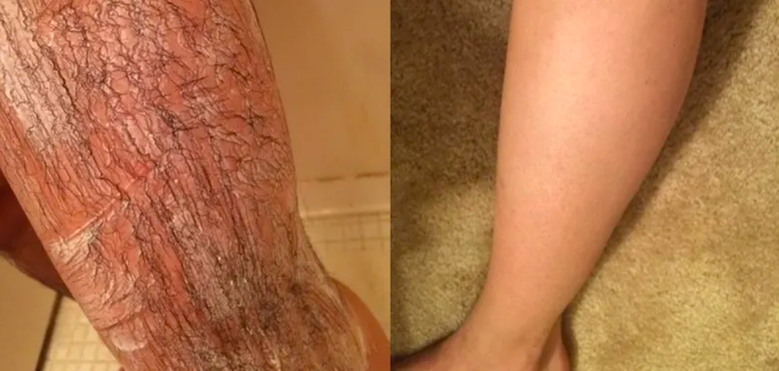 A reviewer’s leg covered in long, dark hair after applying the cream, followed by a picture of their leg completely hairless.
