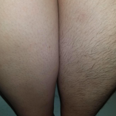 Reviewer with one thigh still covered in hair while the other has been shaved with the product.
