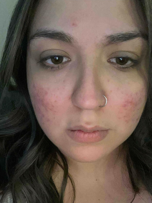 A photo of a reviewer displaying acne and redness on their skin