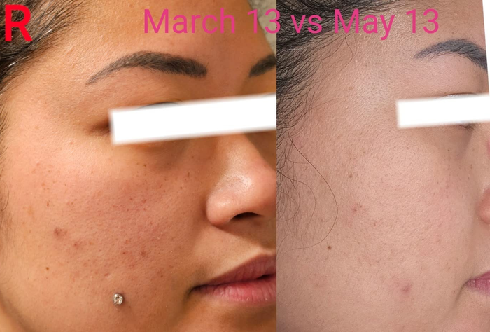 side-by-side before images of a reviewer showing clogged pores and acne that gradually clear up