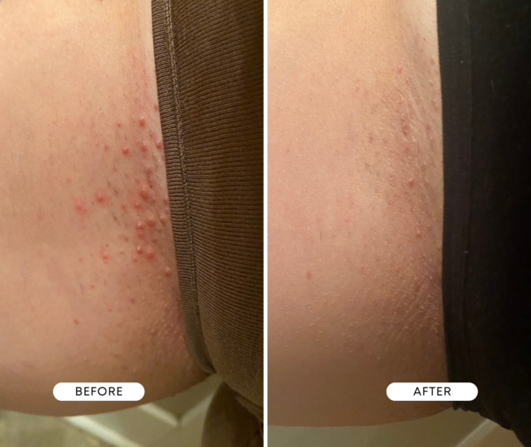 A split image of a reviewer showing razor bumps significantly reduced after a month of using the oil