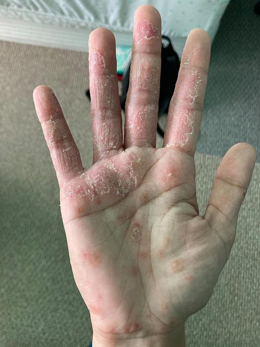 before image of a reviewer's hand displaying dry, flaky skin