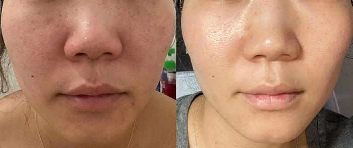 Side-by-side images of a woman showcasing visibly smoother and clearer skin after following a specific skincare treatment or routine