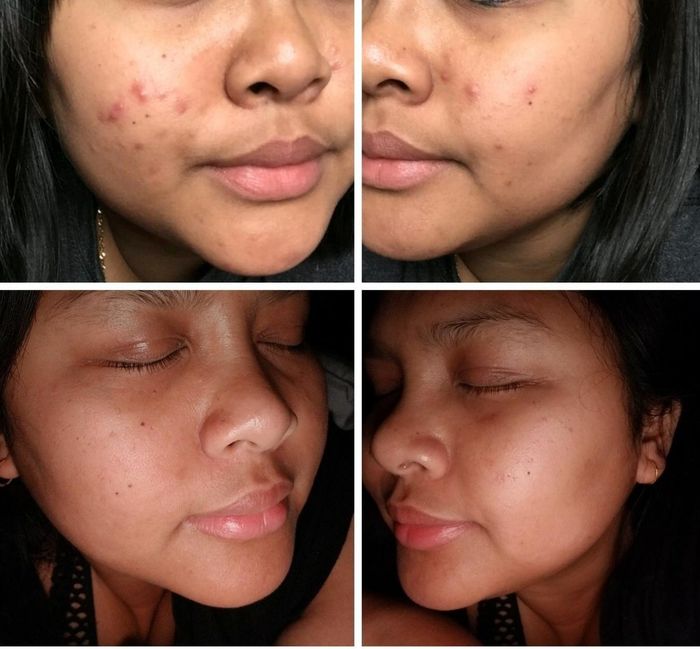 A before-and-after comparison of a reviewer: the first photo shows cheek breakouts and acne scars, while the second reveals smoother, more even skin with no breakouts
