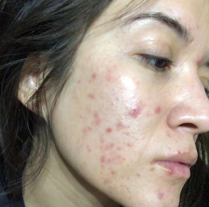 before image of a reviewer with visible acne and red marks