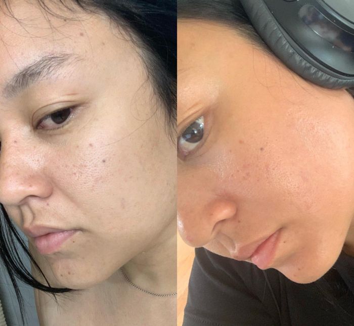 Side-by-side photos of a reviewer showing clogged pores and acne before treatment, followed by clear and smooth skin afterward