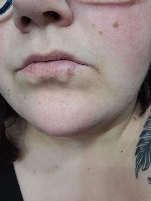 A photo of a patch applied to a cold sore on the reviewer's lip