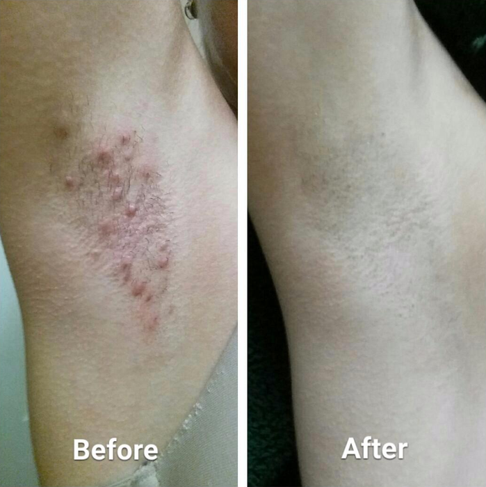 Reviewer's armpit showing severe redness, swelling, and razor bumps before, and completely clear skin after