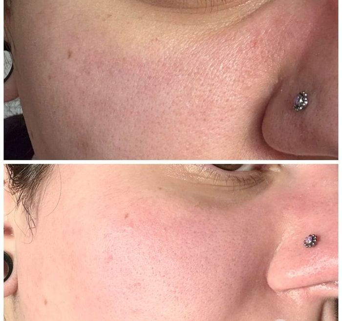 A reviewer displaying visible nose pores in one image and significantly clearer, reduced pores in the follow-up photo