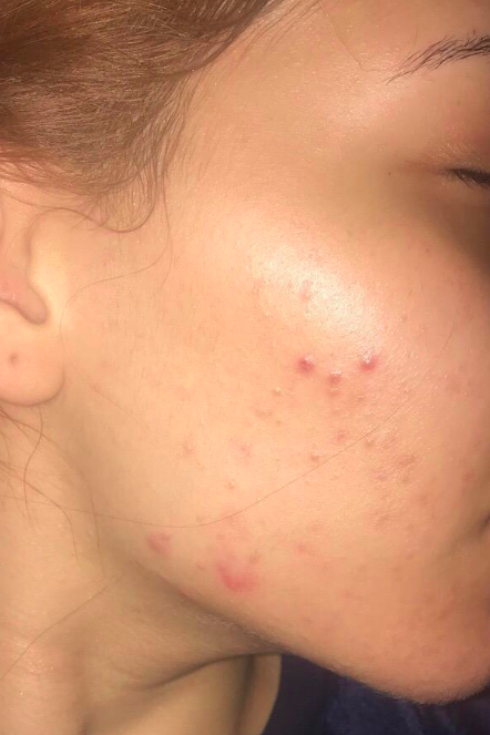 A reviewer’s photo showing skin after using the rosehip oil, with a significant reduction in redness