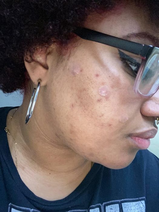 Reviewer wearing the acne patch.