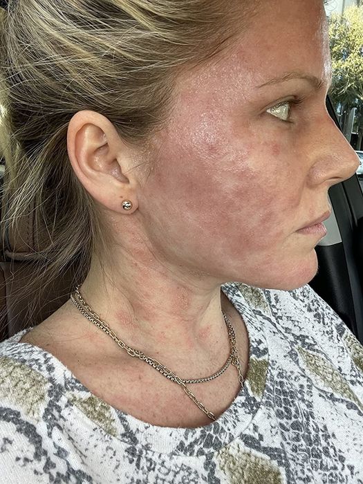 The condition of a reviewer's skin prior to applying Vanicream