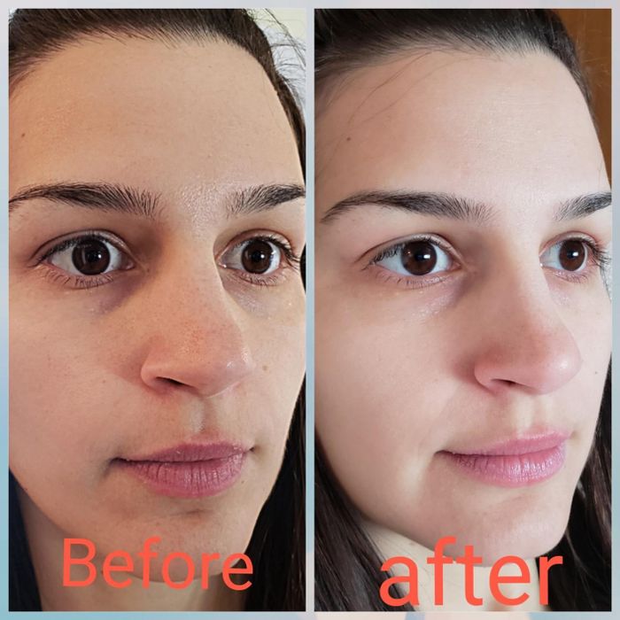 The reviewer's skin before and after using the mask, showing a noticeable reduction in pore size.