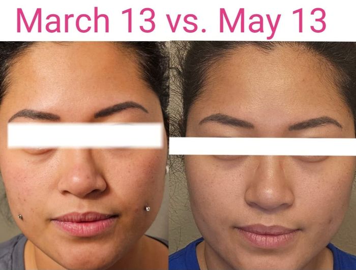A reviewer's before-and-after images revealing a reduction in acne scars and a more even skin tone.