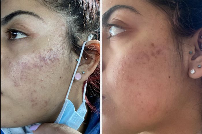 Before and after images showing a reviewer's irritated skin becoming clear and calm after use