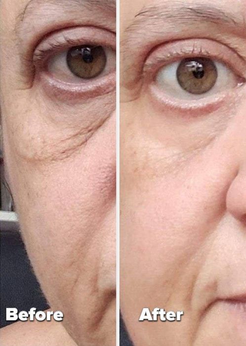 A before-and-after photo from a reviewer showing a noticeable reduction in their under-eye bags over time