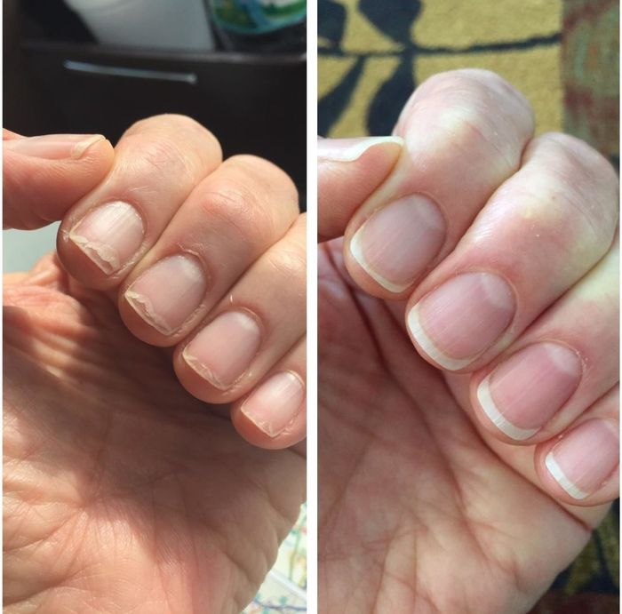 A before image showing the reviewer’s brittle nails, followed by an after image with visibly healthier nails.